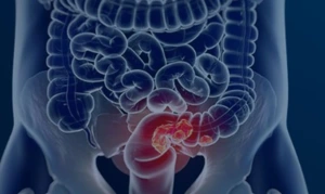 Câncer de intestino deve ter 145 novos casos por dia no Brasil em 2026